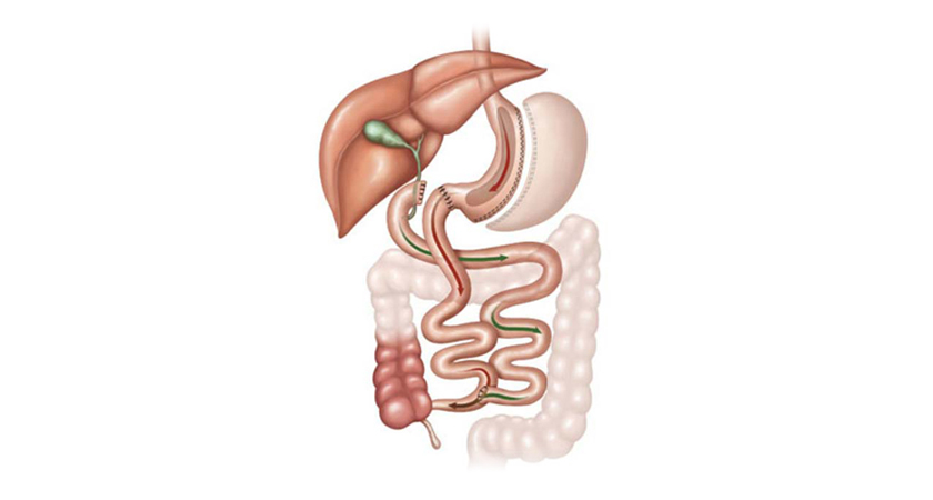 Infografia de un switch duodenal