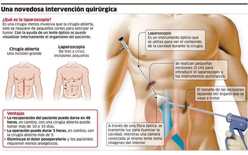 cirugia laparoscópica